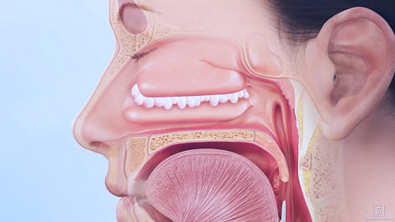 Nasal Polyps San Diego | Nasal Inflamation Chula Vista